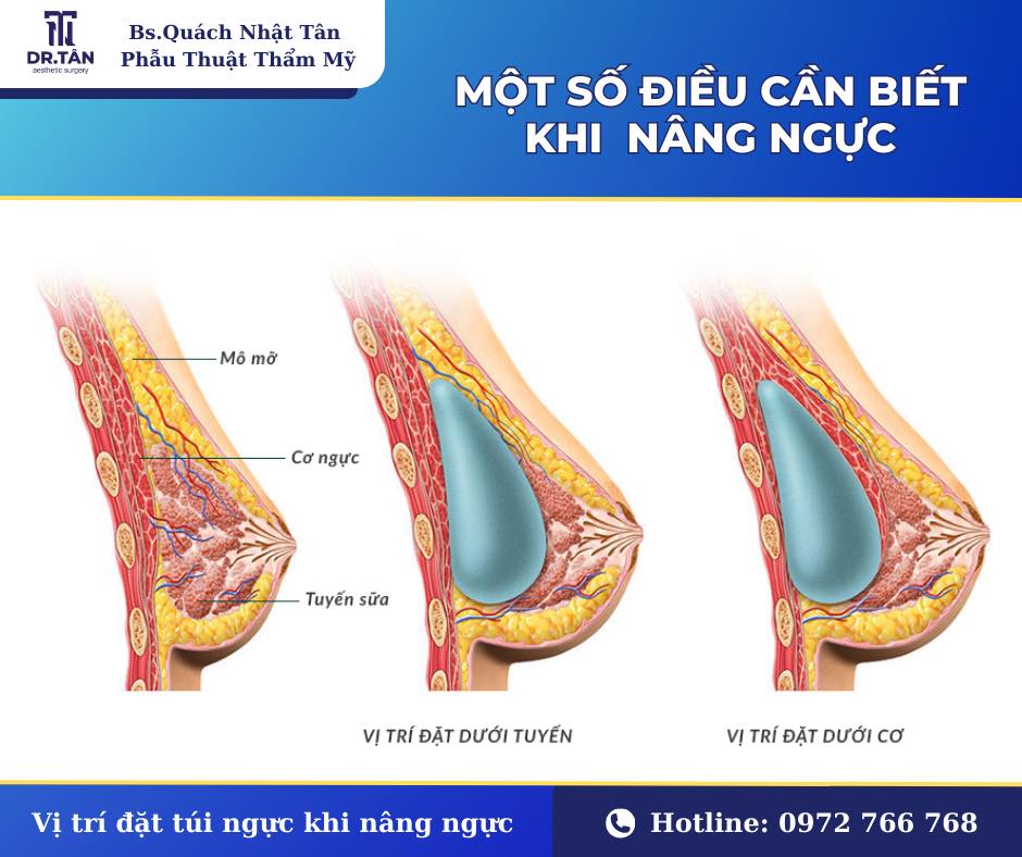 Nâng ngực có để lại sẹo không