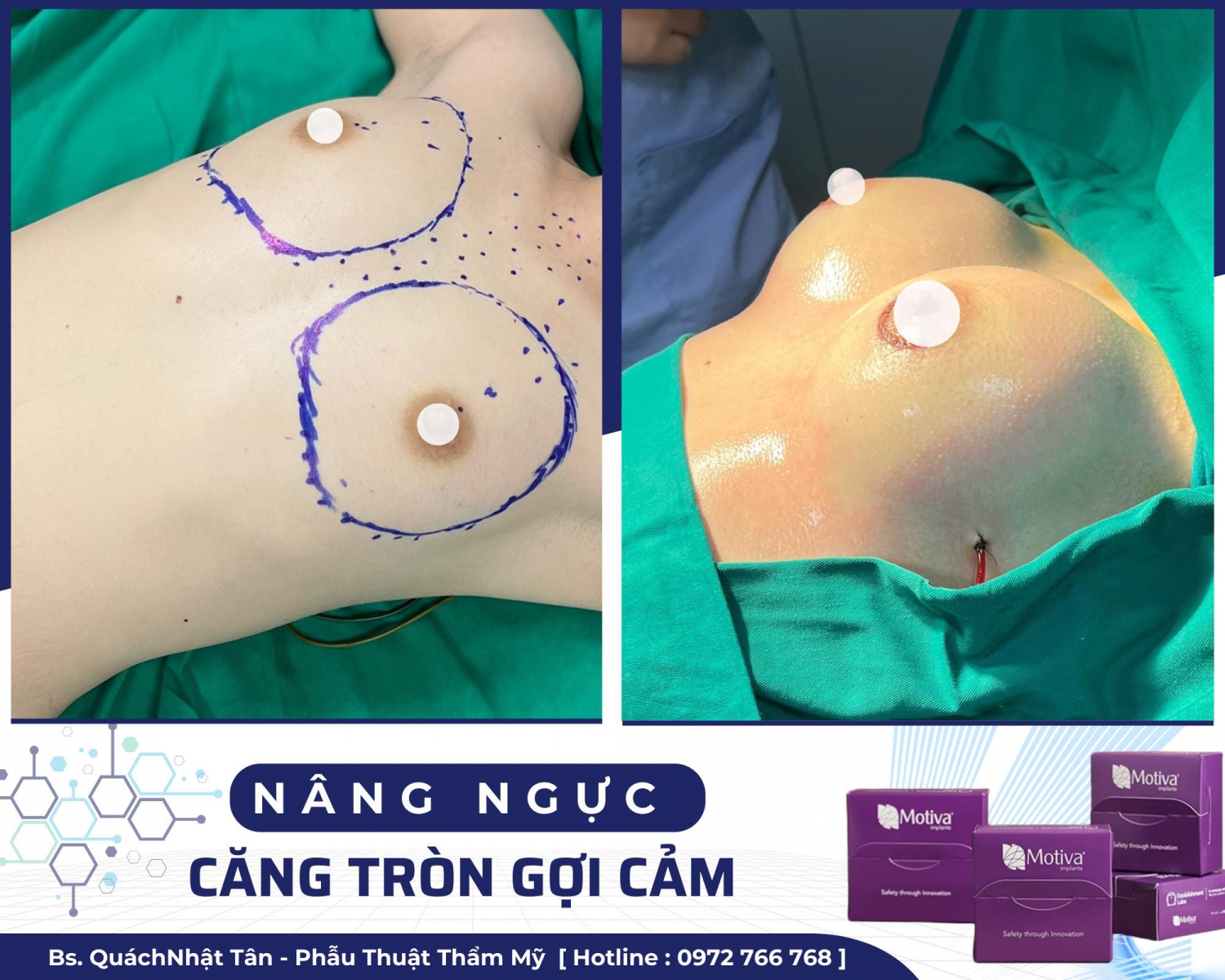 Nâng ngực gợi cảm